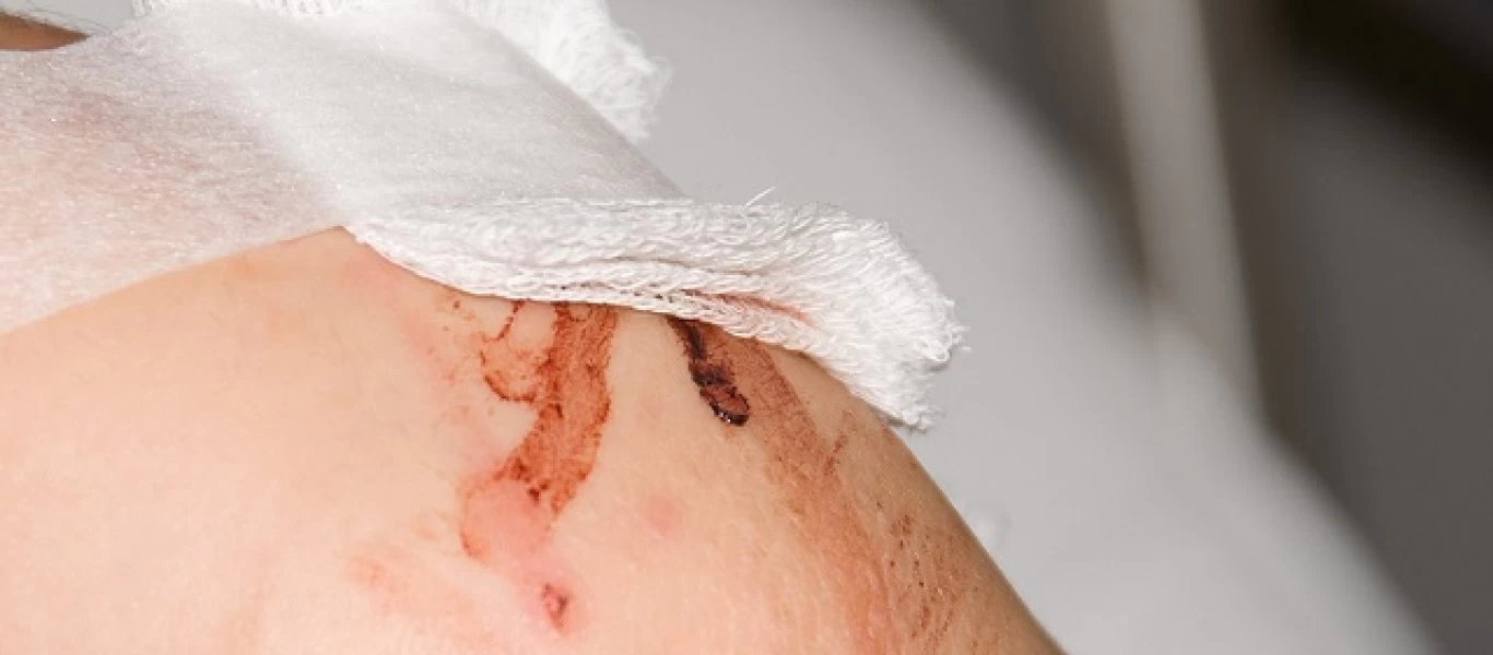 Θα σας «σώσουν»: Αυτά είναι τα τέσσερα καλύτερα γιατροσόφια για πληγές και κοψίματα